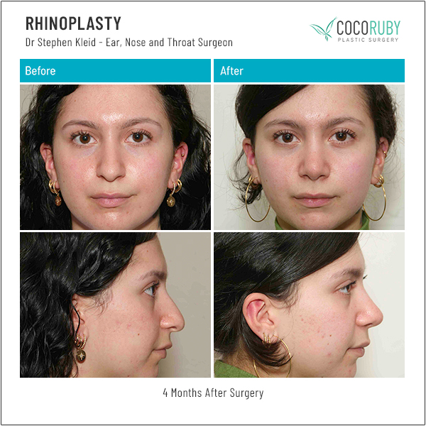 1_rhinoplasty_dr Kleid