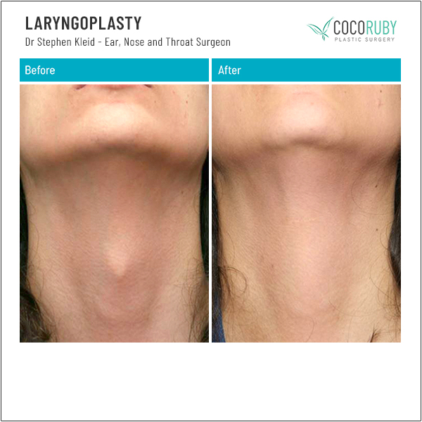 LARYNGOPLASTY Patient 1Dr Stephen Kleid Melbourne