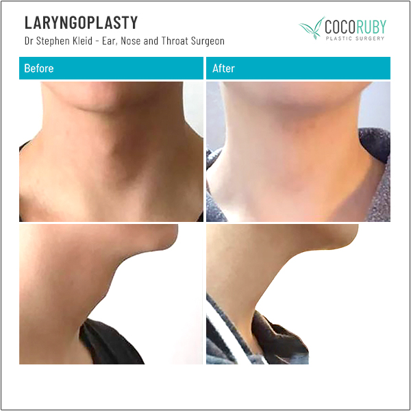 LARYNGOPLASTY Patient 1Dr Stephen Kleid Melbourne - Adams apple