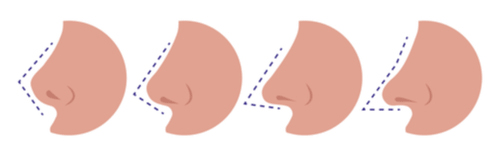 Tip-Rhinoplasty-Dr-Kleid-Melbourne_