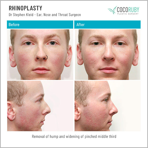 dr-stephen-kleid-rhinoplasty
