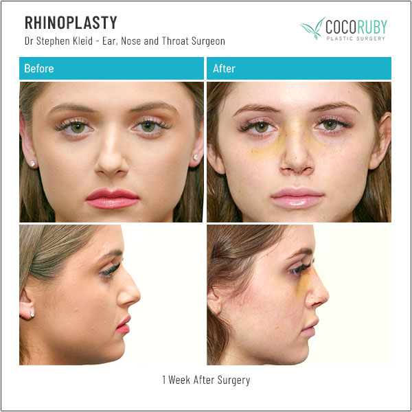 dr-stephen-kleid-rhinoplasty-