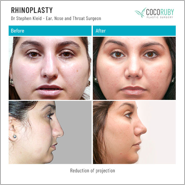 dr-stephen-kleid-rhinoplasty