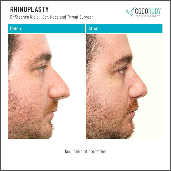 dr-stephen-kleid-rhinoplasty