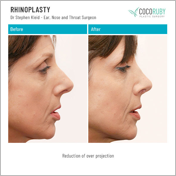 dr-stephen-kleid-rhinoplasty