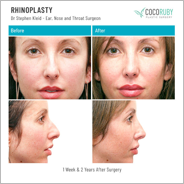 dr-stephen-kleid-rhinoplasty