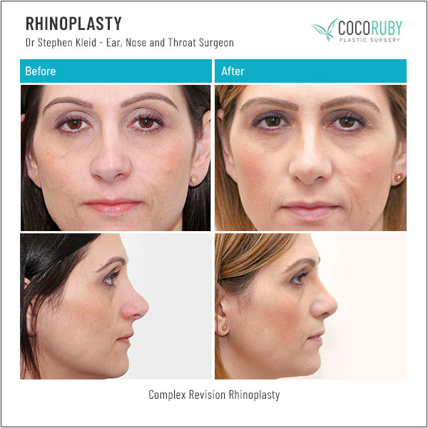 dr-stephen-kleid-rhinoplasty