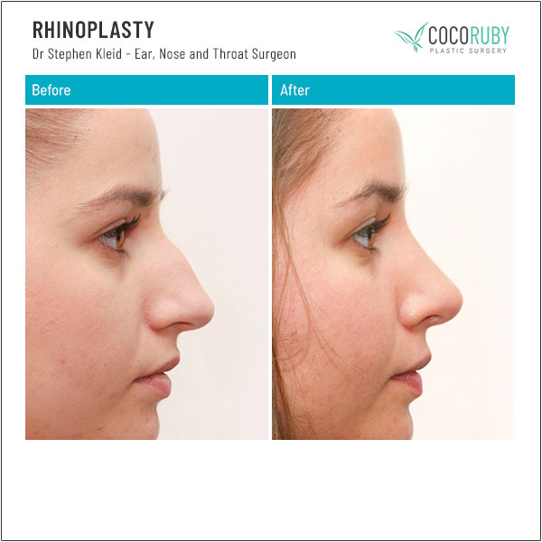 dr-stephen-kleid-rhinoplasty