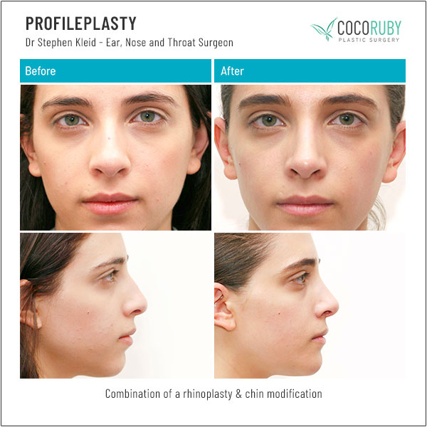 dr-stephen-kleid-rhinoplasty-chin-augmentation-10