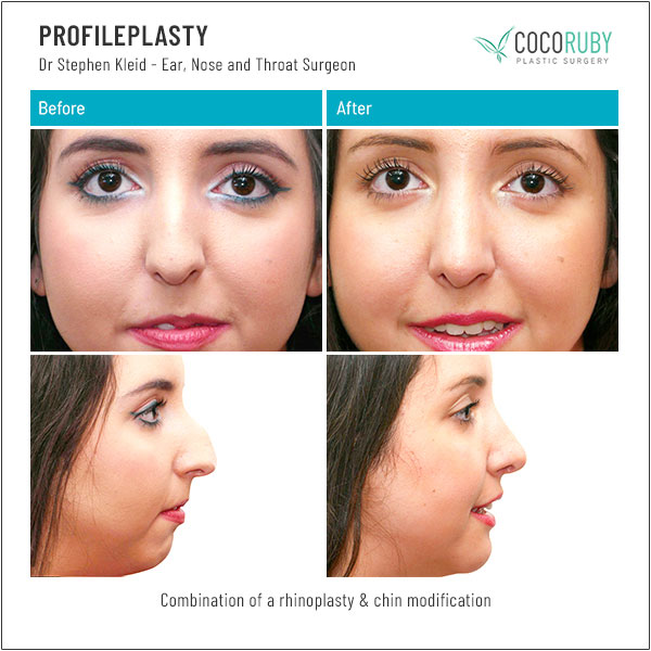 dr-stephen-kleid-rhinoplasty-chin-augmentation-10