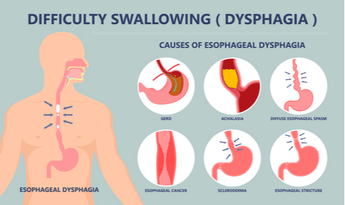 swallowing-Dysphagia_Dr-Kleid_Melbourne