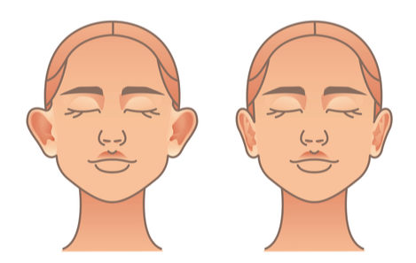 otoplasty ear pinning melbourne3